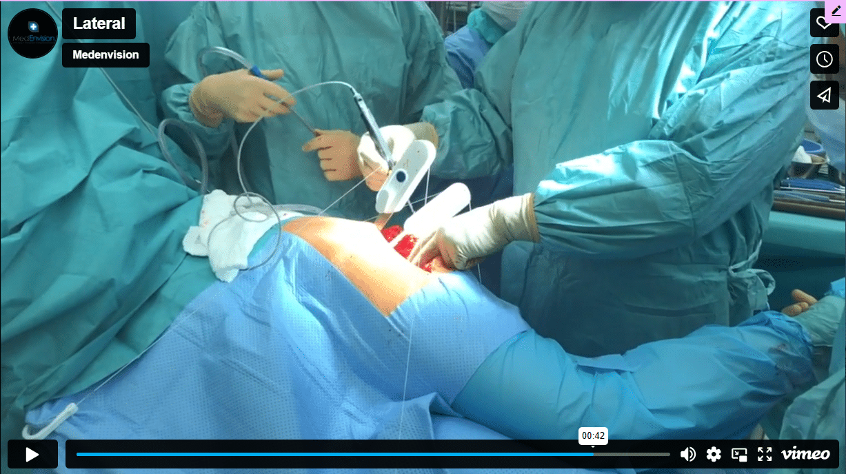 Posterior / lateral hip
