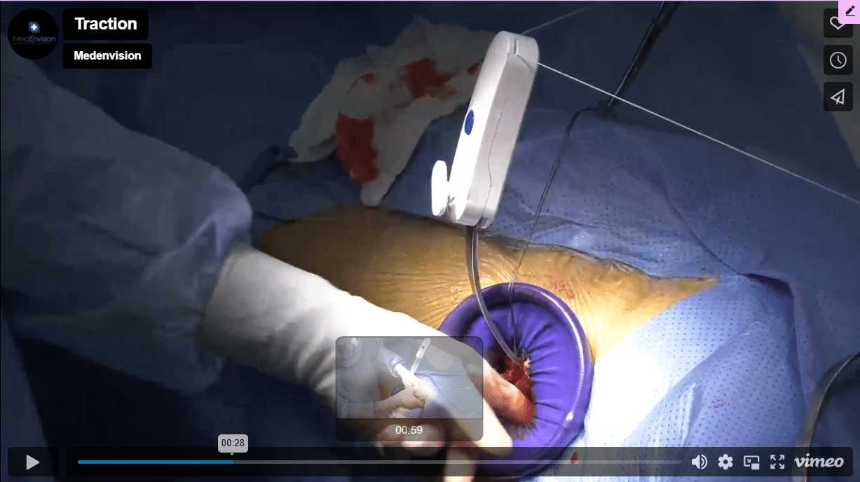 Anterior hip — traction table